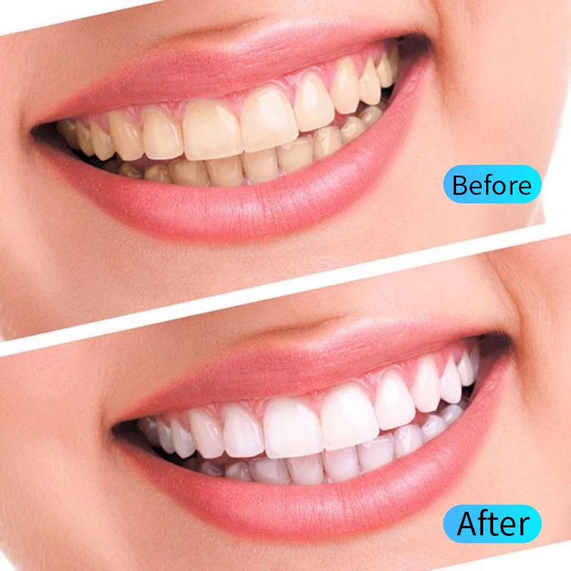 Teeth Whitening Gel Kit Oral H - Teeth Whitening Filter review and price