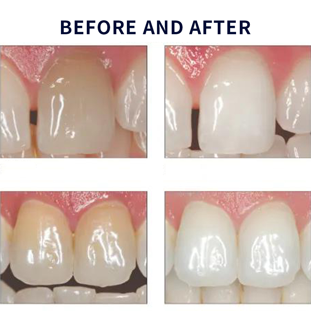 Opalescence Whitening 20% PF 2 - Teeth Whitening In Office review and price