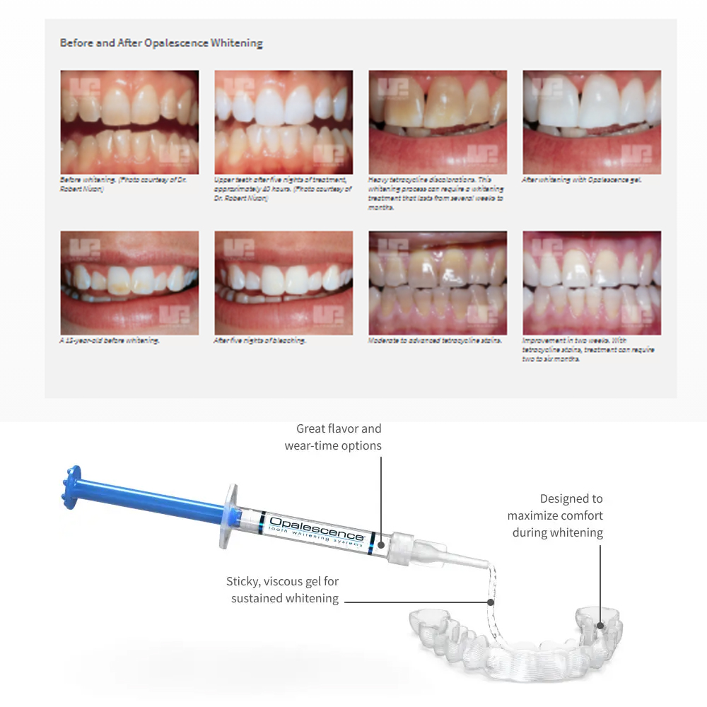 Opalescence Whitening 20% PF 2 - Teeth Whitening In Office review and price
