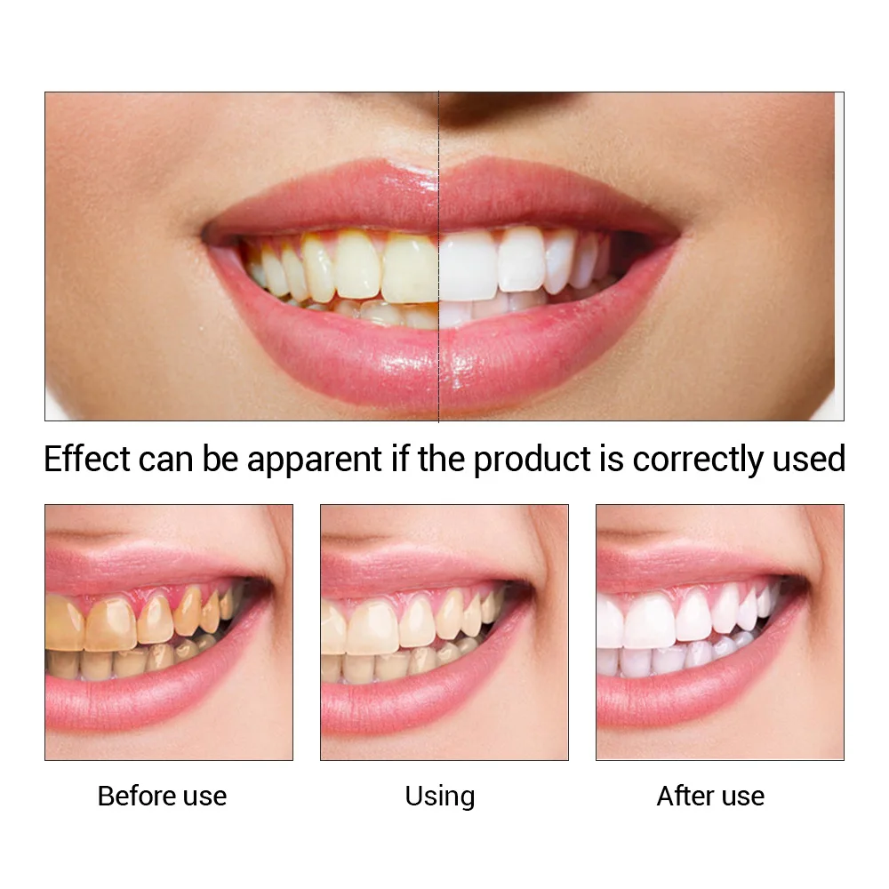 FTEENPLY Teeth Whitening Essen - Teeth Whitening Ingredients review and price