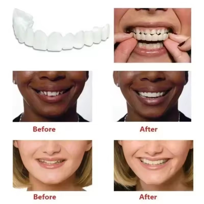 Teeth Veneers Whitening Dentur - Teeth Whitening Session review and price