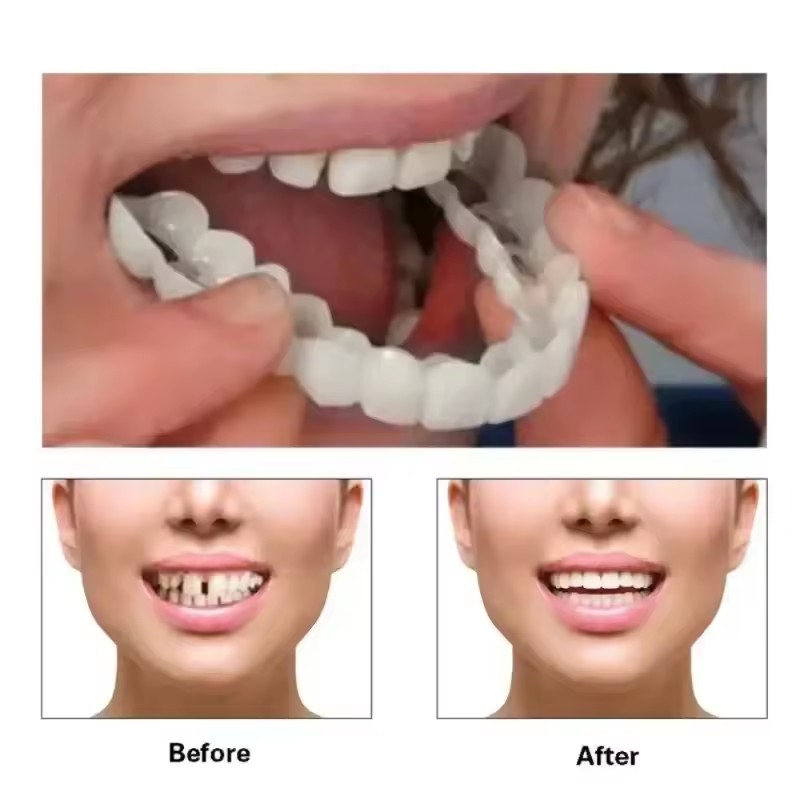 Teeth Veneers Whitening Dentur - Teeth Whitening Session review and price