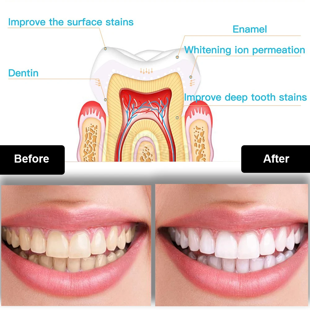 Dental Teeth Whitening Kit Min - Teeth Whitening Ai review and price